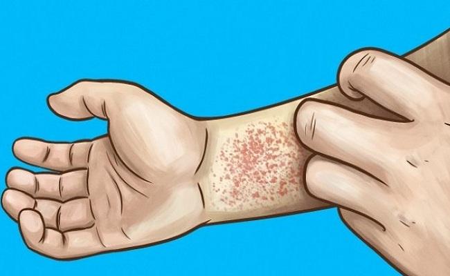 Ternyata Bahaya Stres Bikin Alergi dan Fisik Mudah Sakit 