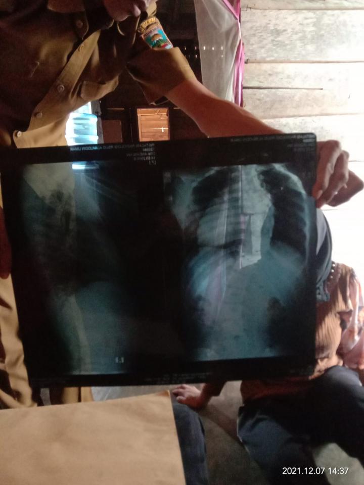 Butuh Bantuan Dana untuk Operasi Pembengkakan Tulang Belakang di RS Fatmawati Jakarta