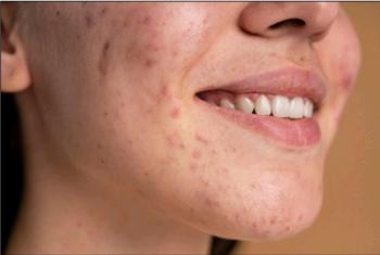 Inilah Rekomendasi Serum Wajah Untuk Jerawat Terbaik