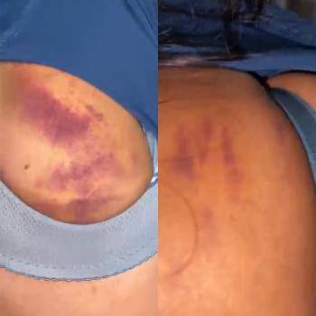 Aniaya ART, Oknum Dokter PNS di Bandarlampung Dilaporkan ke Polisi
