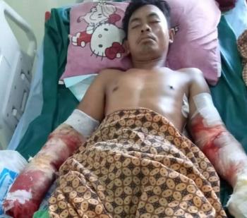 Bantu Kesembuhan Saparudin, Akibat Kesetrum Listrik Saat Pasang Tarub Tangan Sampai Harus Amputasi
