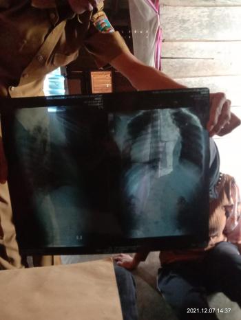 Butuh Bantuan Dana untuk Operasi Pembengkakan Tulang Belakang di RS Fatmawati Jakarta